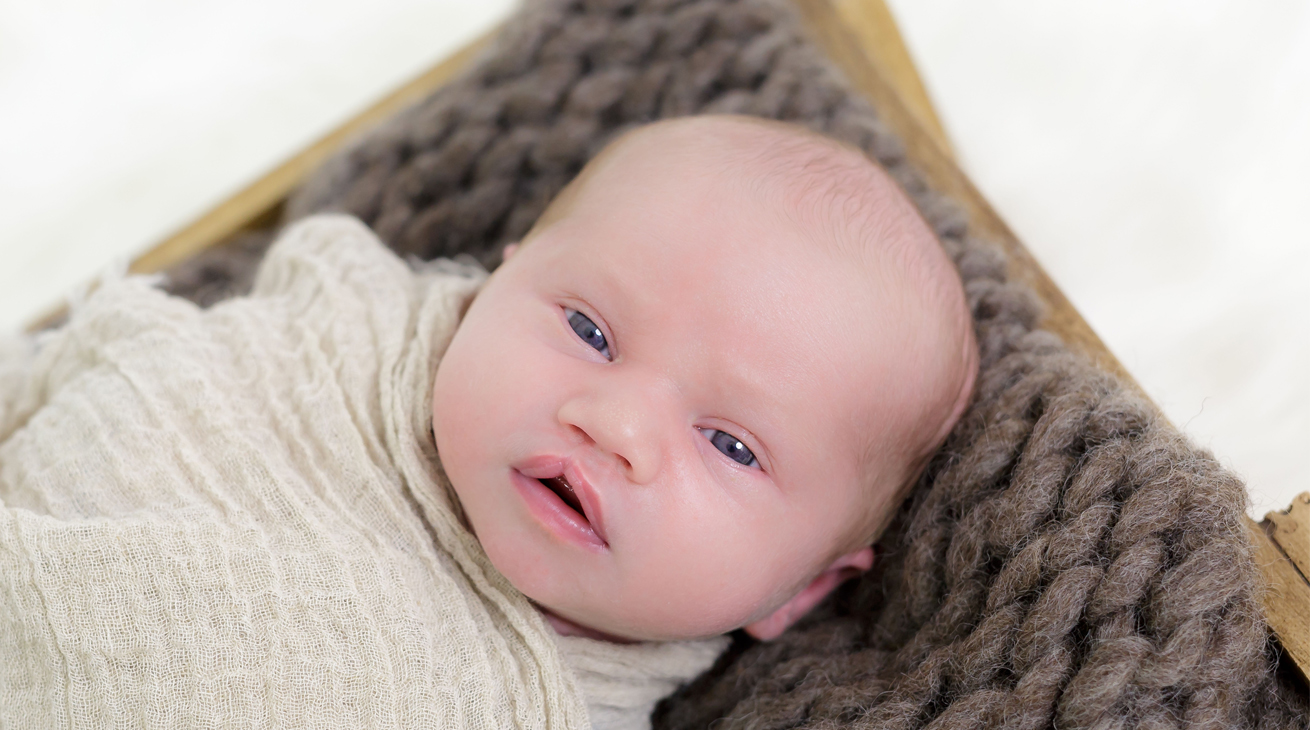 A special little smile: Cameron's cleft lip