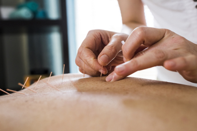 Acupuncture during pregnancy